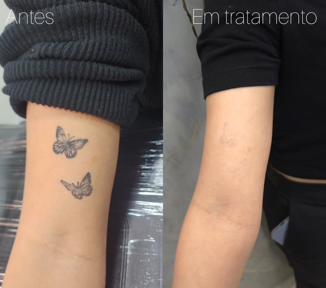 tempo-para-ver-os-resultados-da-remocao-de-tatuagem