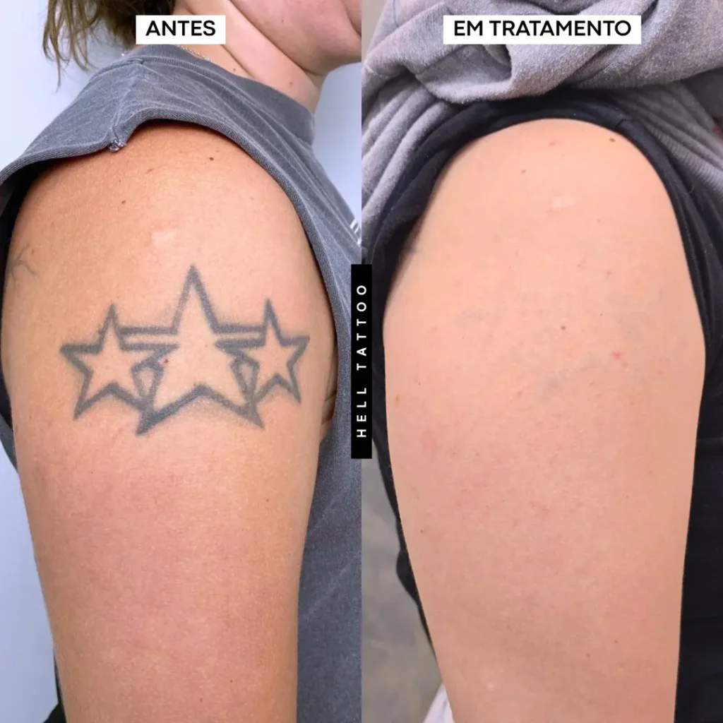 Antes e depois da remoção de tatuagem