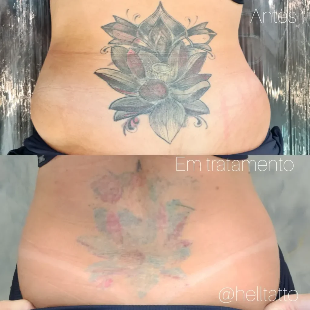 Remoção de tatuagem