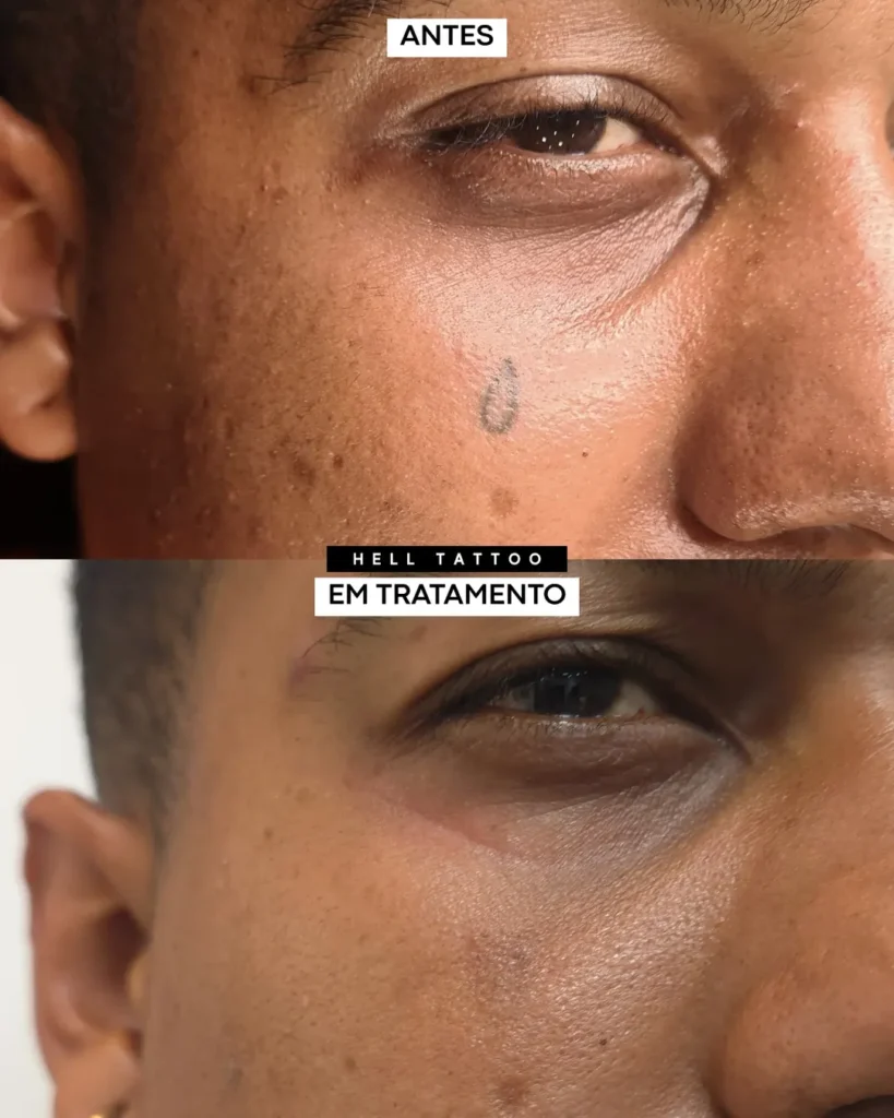Remoção de tatuagem tinta caseira 1