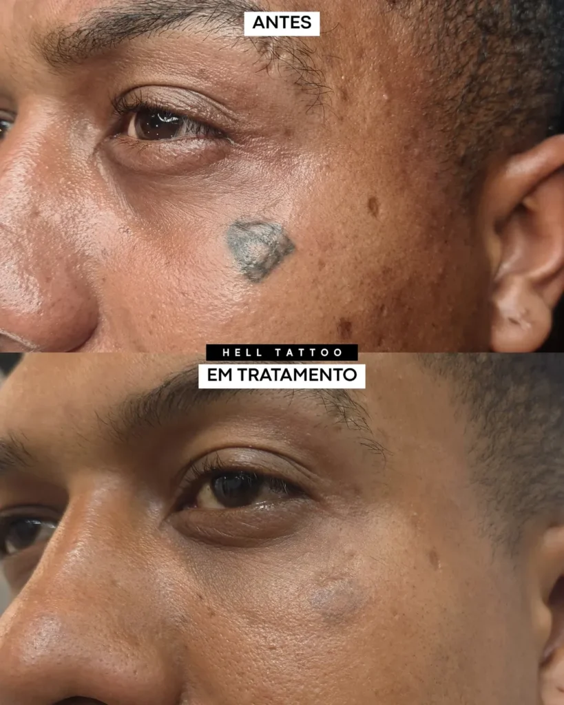 Remoção de tatuagem tinta caseira 2
