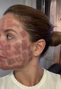 laser co2 fracionado cuidado