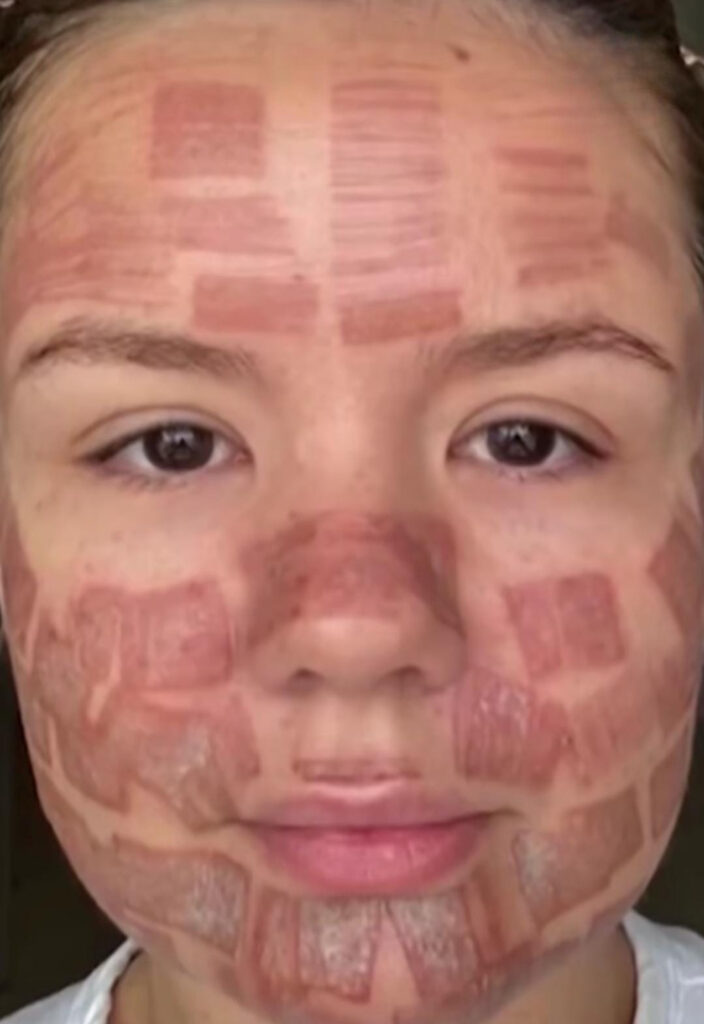 laser de co2 fracionado riscos