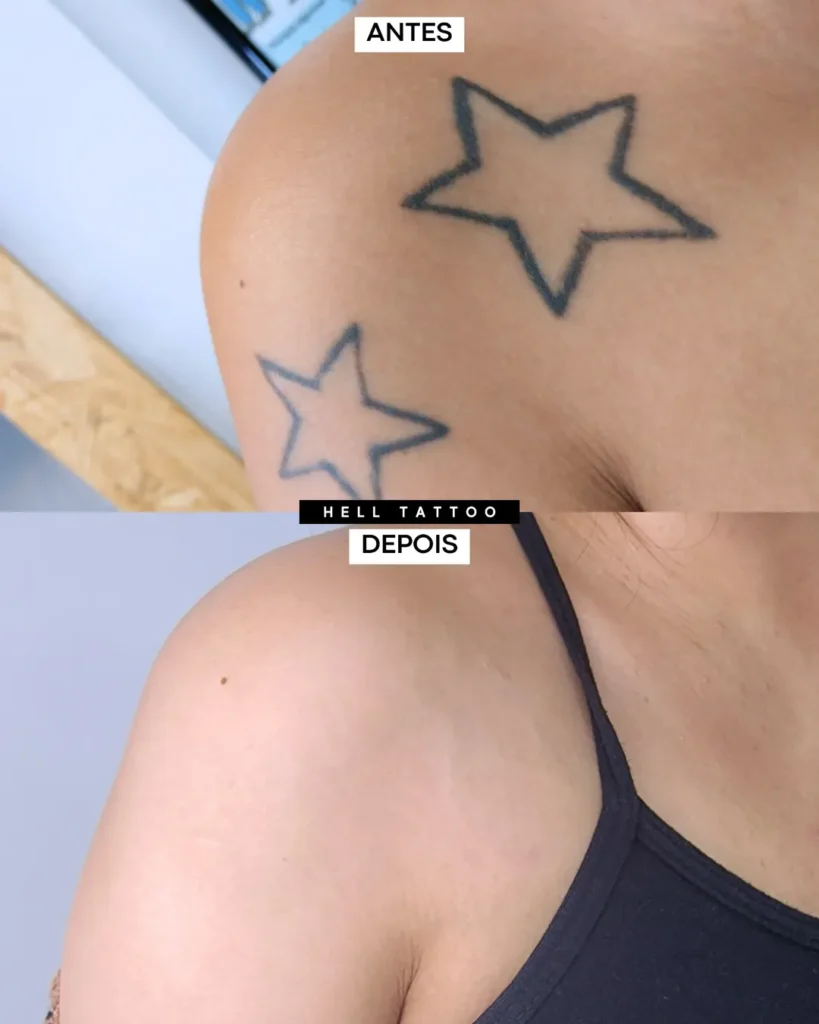 Como-fica-a-marca-de-uma-tatuagem-removida