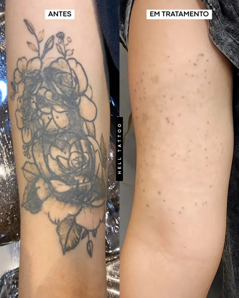 O que tira a tinta da tatuagem_Hell-Tattoo