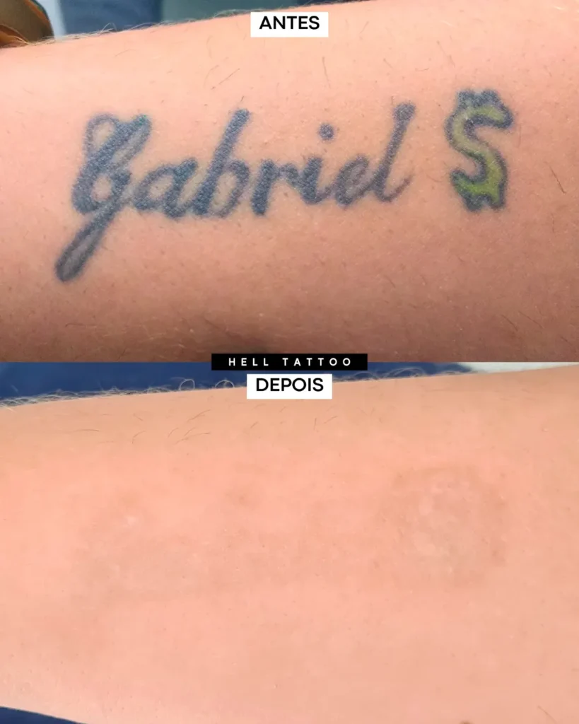 Remoção de tatuagem antes e depois mercado