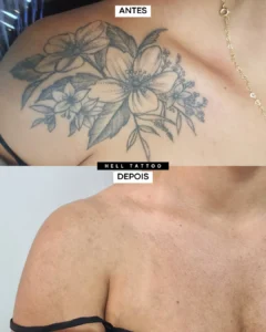 as etapas da remoção de tatuagem 01