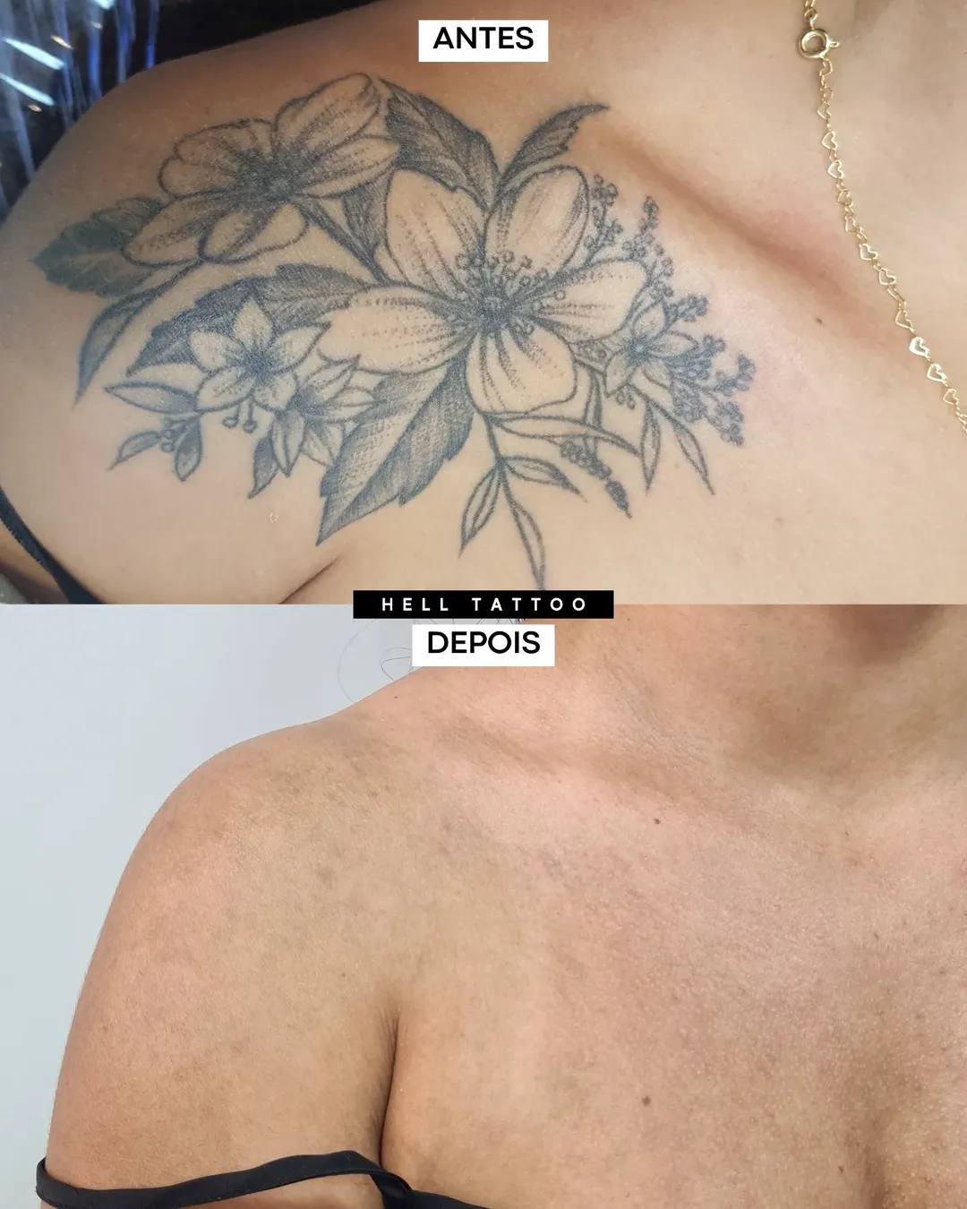 as etapas da remoção de tatuagem 01