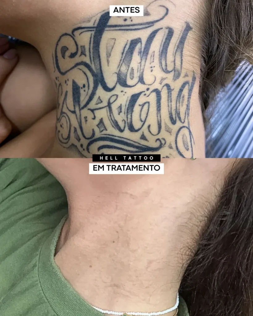 remoção de tatugem antes e depois -2