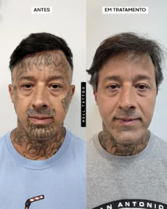remoção de tatuagem 01