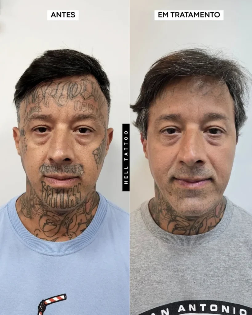 remoção de tatuagem 01