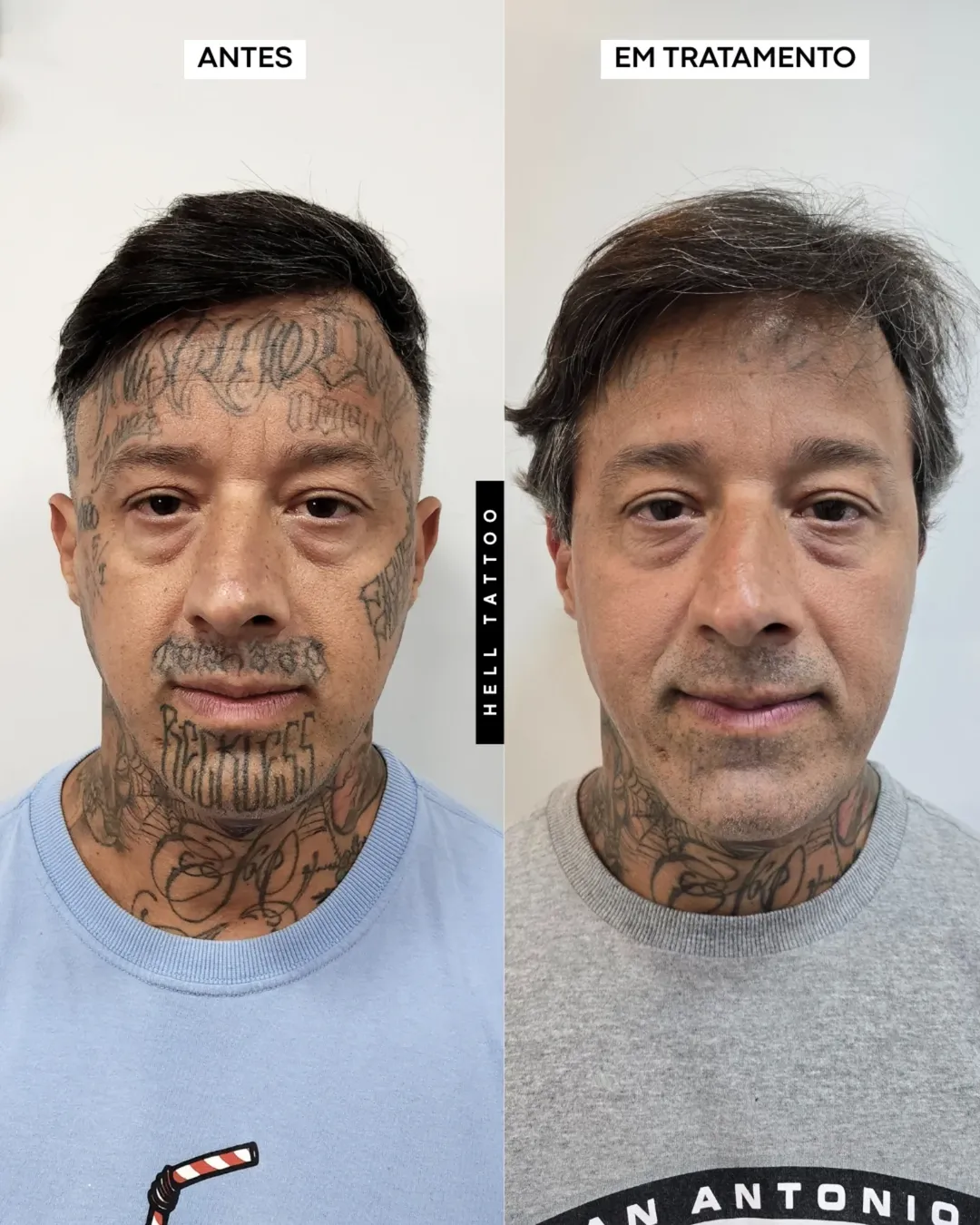 remoção de tatuagem 01