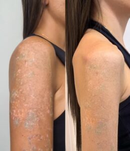 remoção de tatuagem com cicatrizes