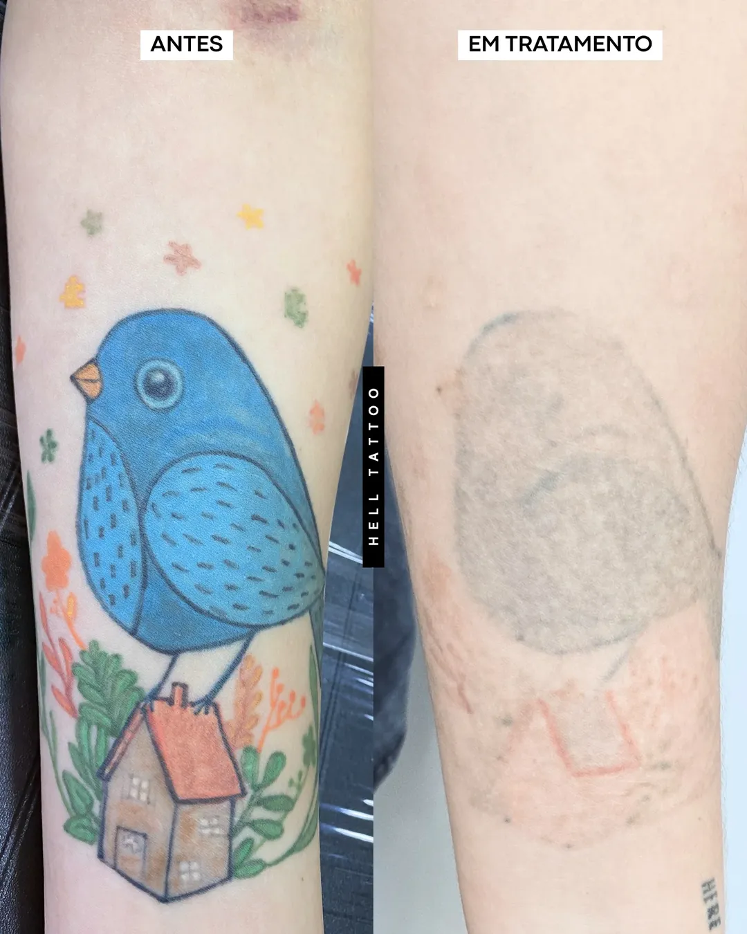 remocao-de-tatuagem-no-carnaval