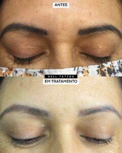 remover micropigmentação