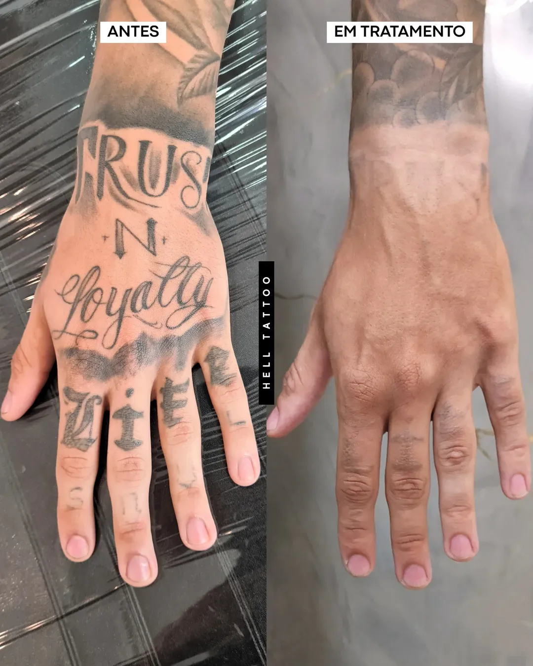 remover tatuagem em casa