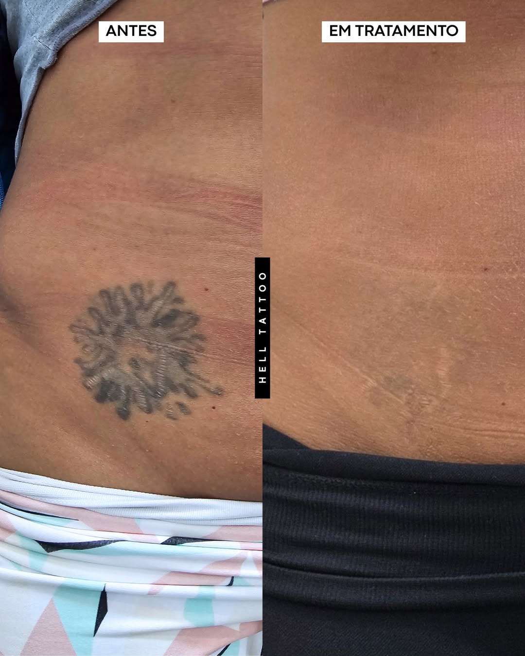 remover tatuagem em regiões íntimas