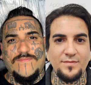 tem-como-remover-tatuagem