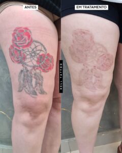 cicatriz-pos-sessao-de-laser-o-erro-que-pode-custar-caro-02