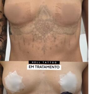 cicatriz-pos-sessao-de-laser-o-erro-que-pode-custar-caro