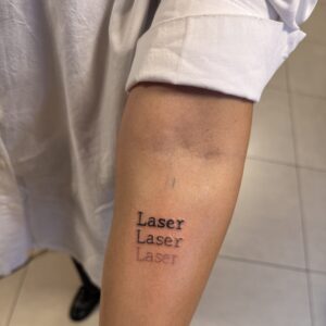 especialista-em-remocao-a-laser-tatua-a-propria-pele-01