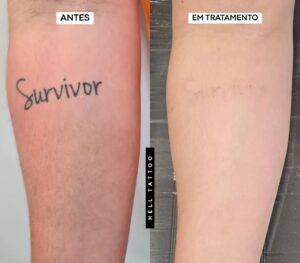 valor-da-remocao-de-tatuagem-na-hell-tattoo-02