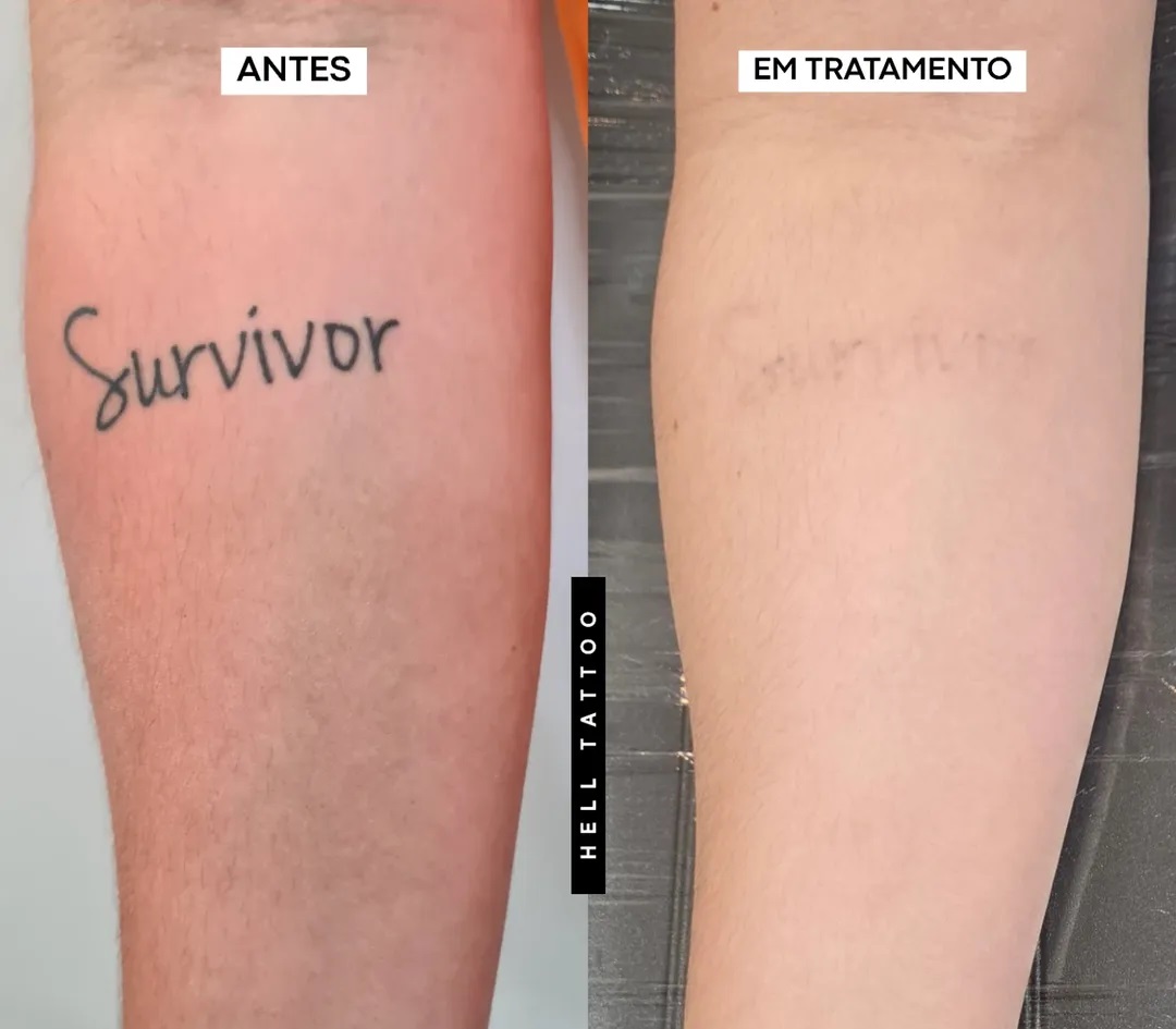 valor-da-remocao-de-tatuagem-na-hell-tattoo-02