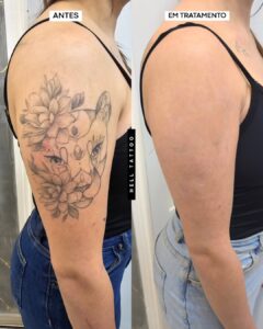 fine line remoção 01