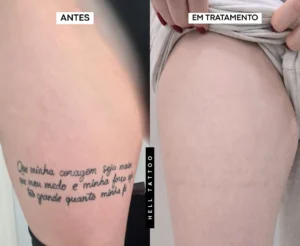 fine line remoção 02