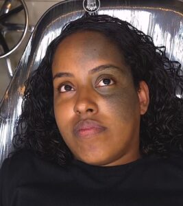 nevo-de-ota-mancha-no-rosto-tem-solucao