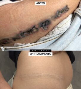 remocao-de-tatuagem-x-queimaduras-entenda-se-e-normal