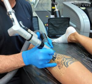 5-clinicas-para-voce-remover-suas-tatuagens-no-brasil