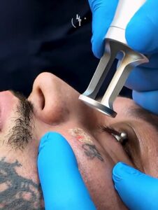 da-para-remover-tattoo-com-laser