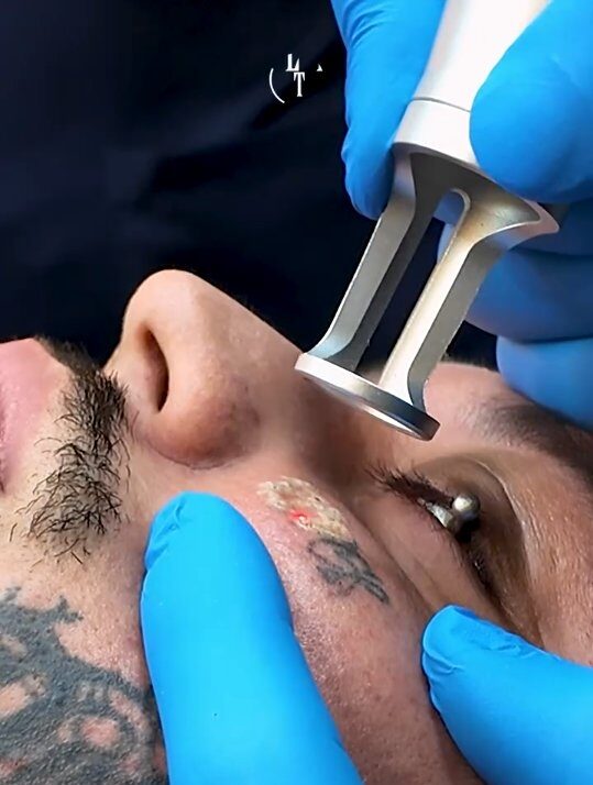 da-para-remover-tattoo-com-laser