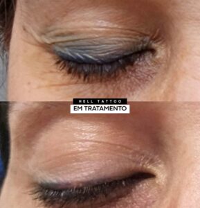 remocao-de-delineado-dos-olhos-e-segura-entenda-o-procedimento