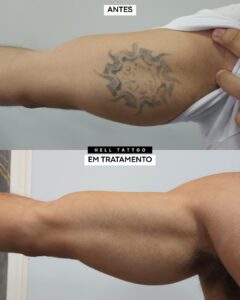 da-para-remover-tatuagem-com-poucas-sessoes