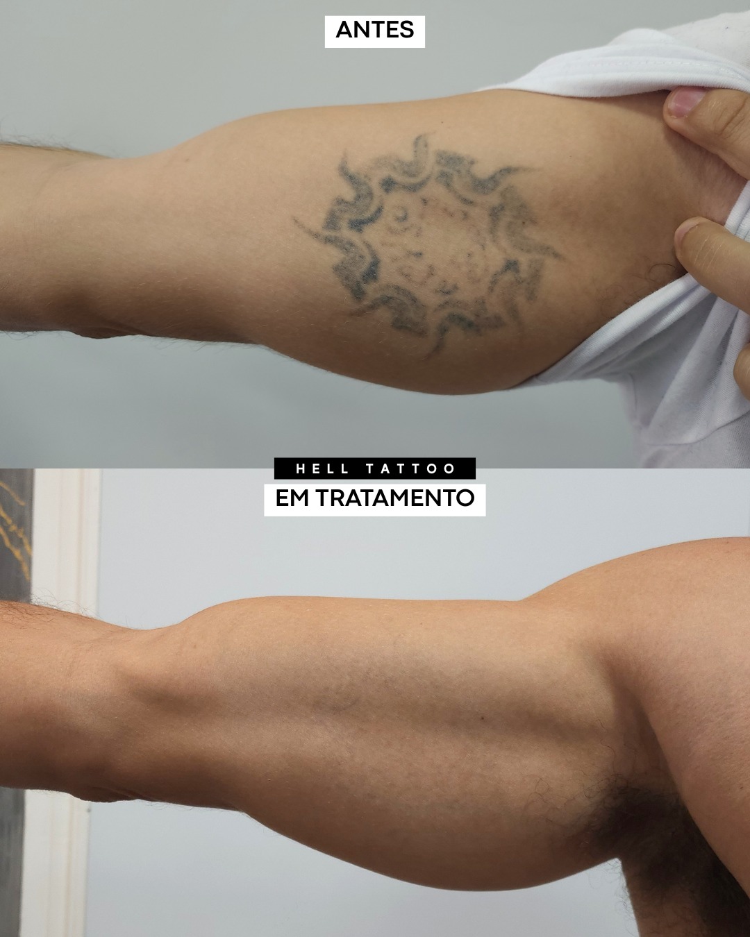 da-para-remover-tatuagem-com-poucas-sessoes