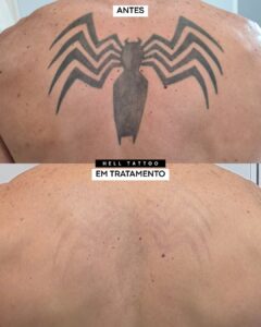 clareamento de tatuagem