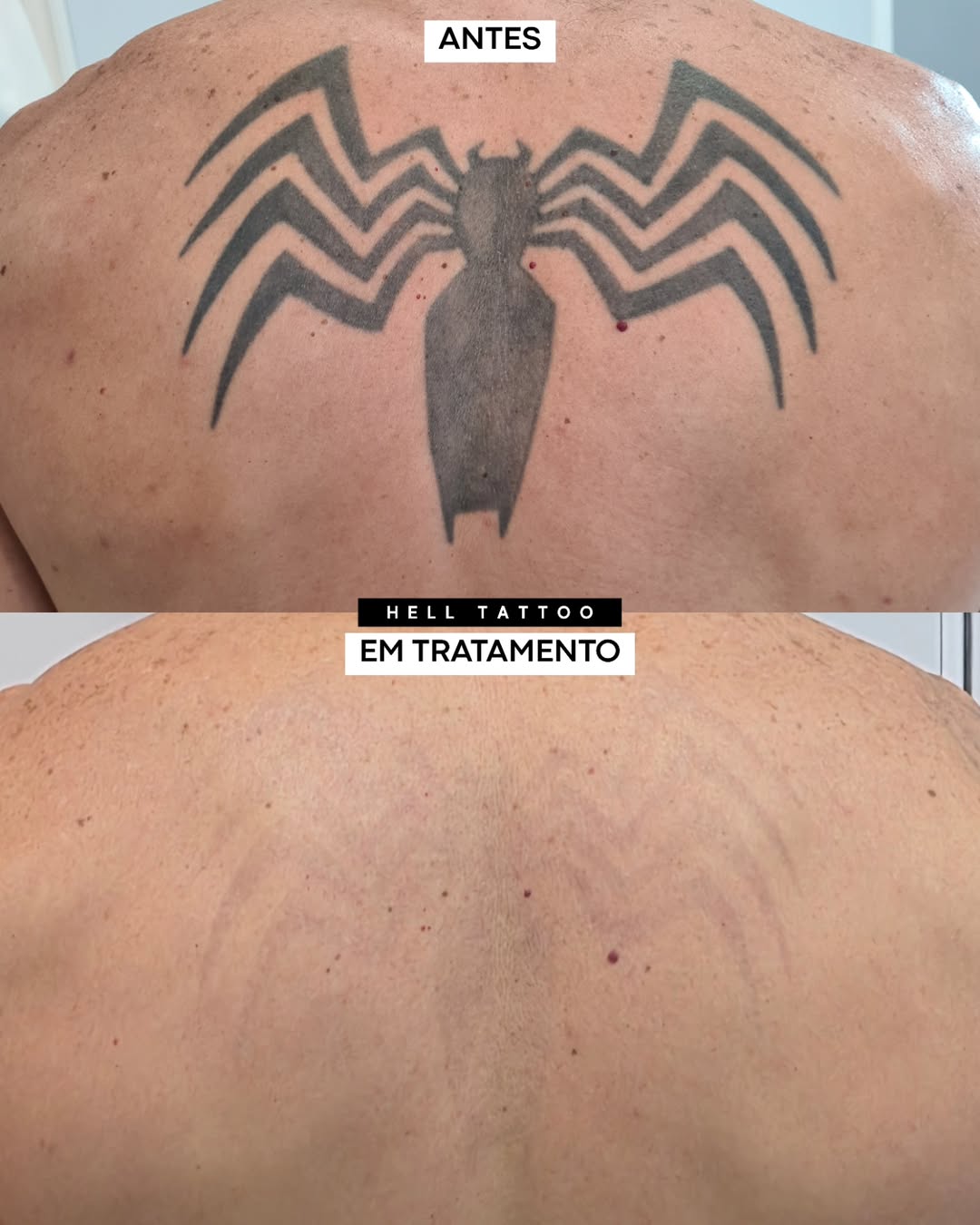 clareamento de tatuagem