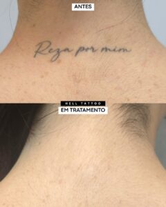 clareamento de tatuagem-02