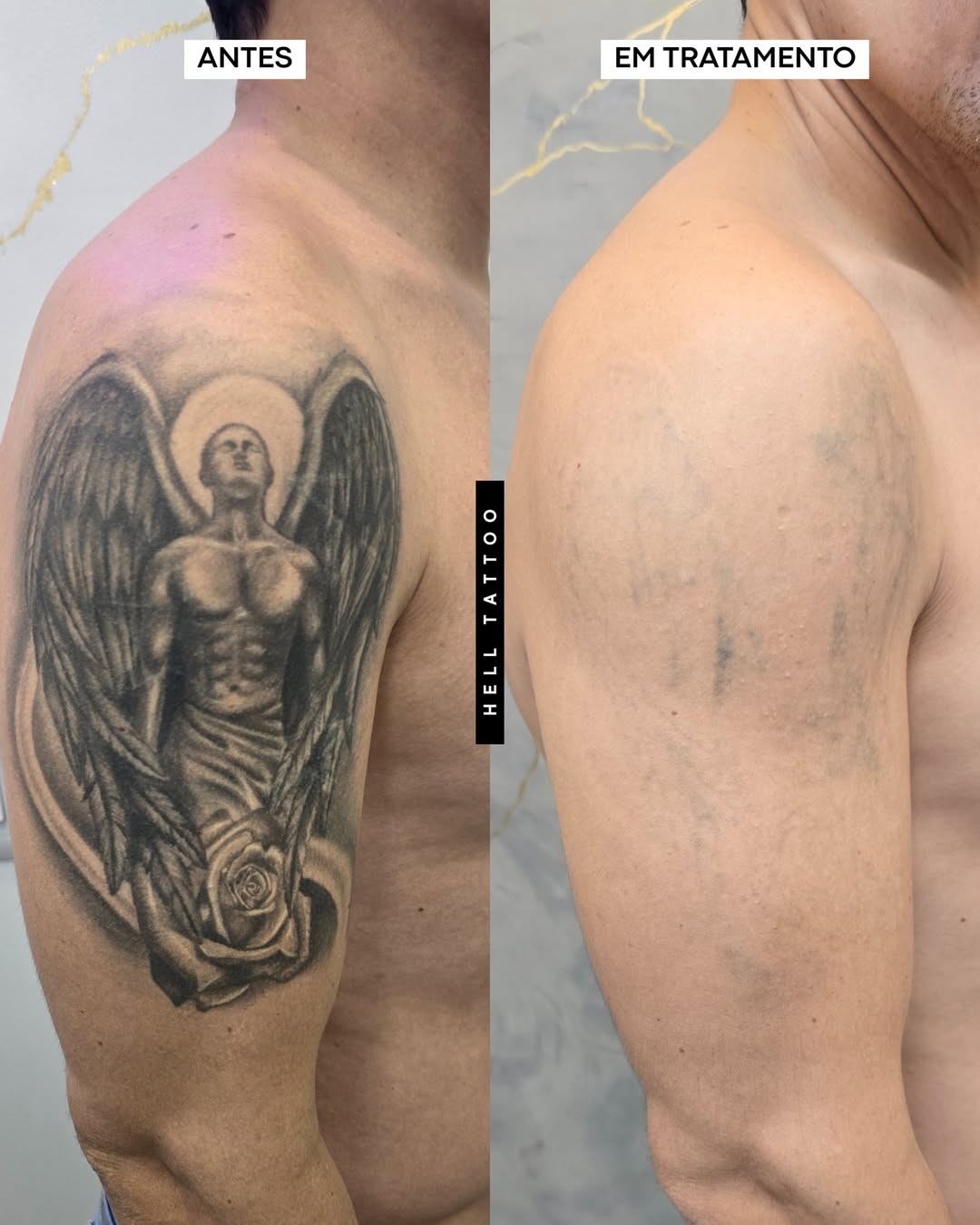 clareamento de tatuagem