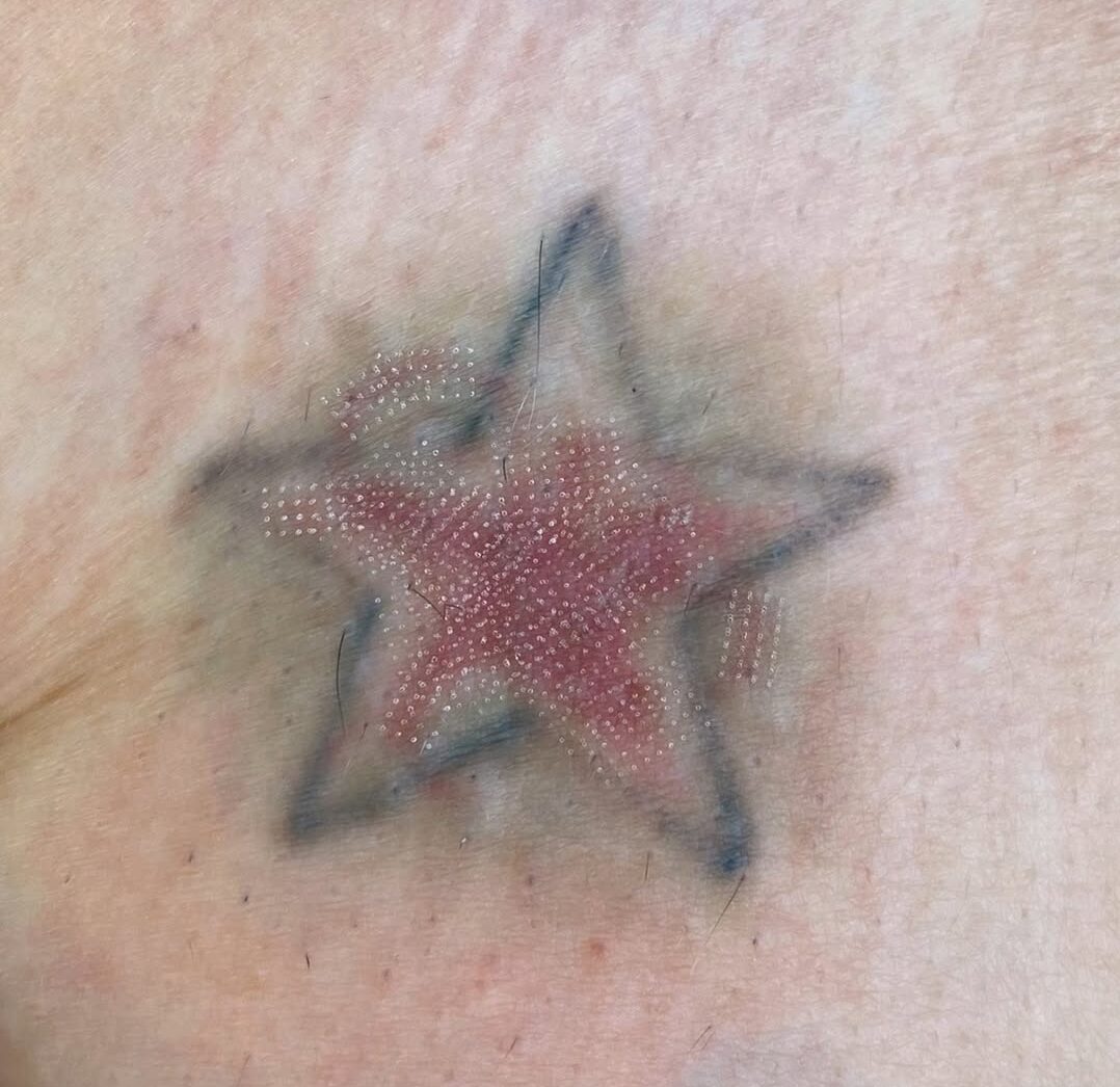 laser-fracionado-pos-remocao-e-bom-entenda