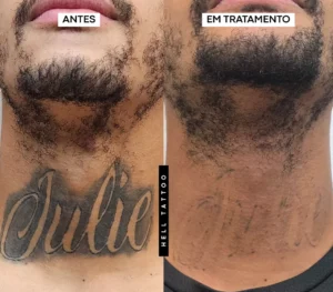 remoção tatuagem de nomes 02