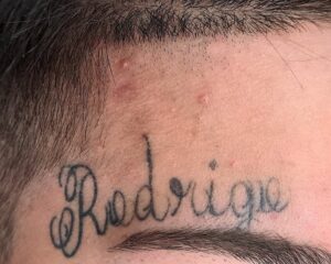 remoção tatuagem de nomes