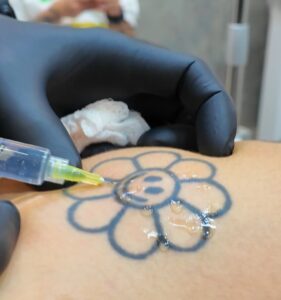 como-a-profundidade-do-pigmento-interfere-na-remocao-de-tatuagem-01