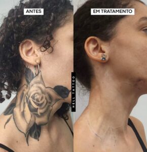 como-a-profundidade-do-pigmento-interfere-na-remocao-de-tatuagem
