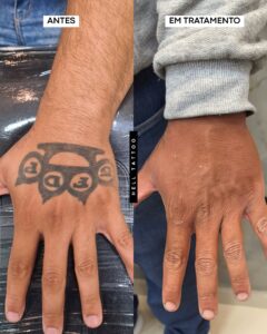 5-diferenciais-da-hell-tattoo-por-que-escolher-uma-clinica-especializada-2