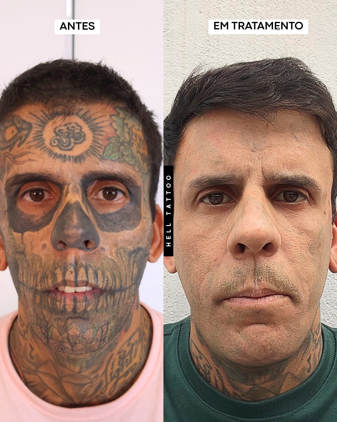 cuidado-com-o-paciente-hell-tattoo-interrompe-temporariamente-remocao-das-tatuagens-de-leandro-de-souza-apos-avaliacao-medica-identificar-alteracao-na-bexiga - Foto: Hell Tattoo