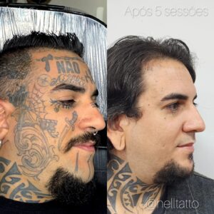fortaleza remoção de tatuagens no rosto