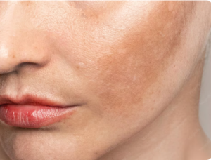 melasma - Foto - Freepik